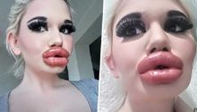 This Girl Who Is 22, Spends Thousands On Lip Injections To Have The World’s Biggest Lips