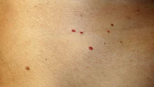 Red dots on your skin: Causes and what they might represent