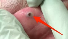 Dr. Pimple Popper posts behind-the-ear blackhead video on social media