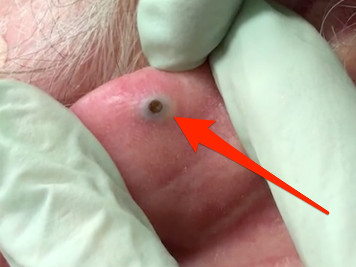 Dr Pimple Popper Posts Behind The Ear Blackhead Video On Social Media Top Stories 4694