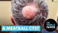 Meatball Sized Cyst being Extracted from Patient Head