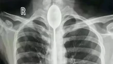 Doctors Retrieve Spoon from Man’s Esophagus — A Year After He Swallowed It