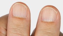 What Could Mean For Your Body Having Striped Nails