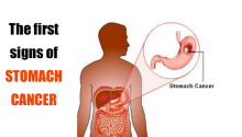 Cᴀɴᴄᴇʀ in the stomach develops silently. These are the first signs! You should be attentive!