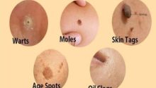 Home Solutions for Dealing with Age Spots, Moles, Skin Tags, Warts, and Blackheads