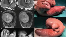 Teaching NeuroImage: Intraventricular Fetus-in-Fetu With Extensive De Novo Gain in Genetic Copy Number