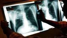 Kansas Tuberculosis Outbreak, Largest in US History, Hits 67 Active Cases Across Two Counties – Latest Details